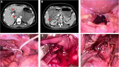 Management of liver trauma by laparoscopy using infrahepatic inferior vena cava partial clamping: A case report